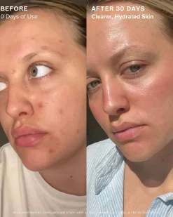 Clear Skin Mineral Milk 2% Salicylic Acid Acne Treatment with Niacinamide + Copper