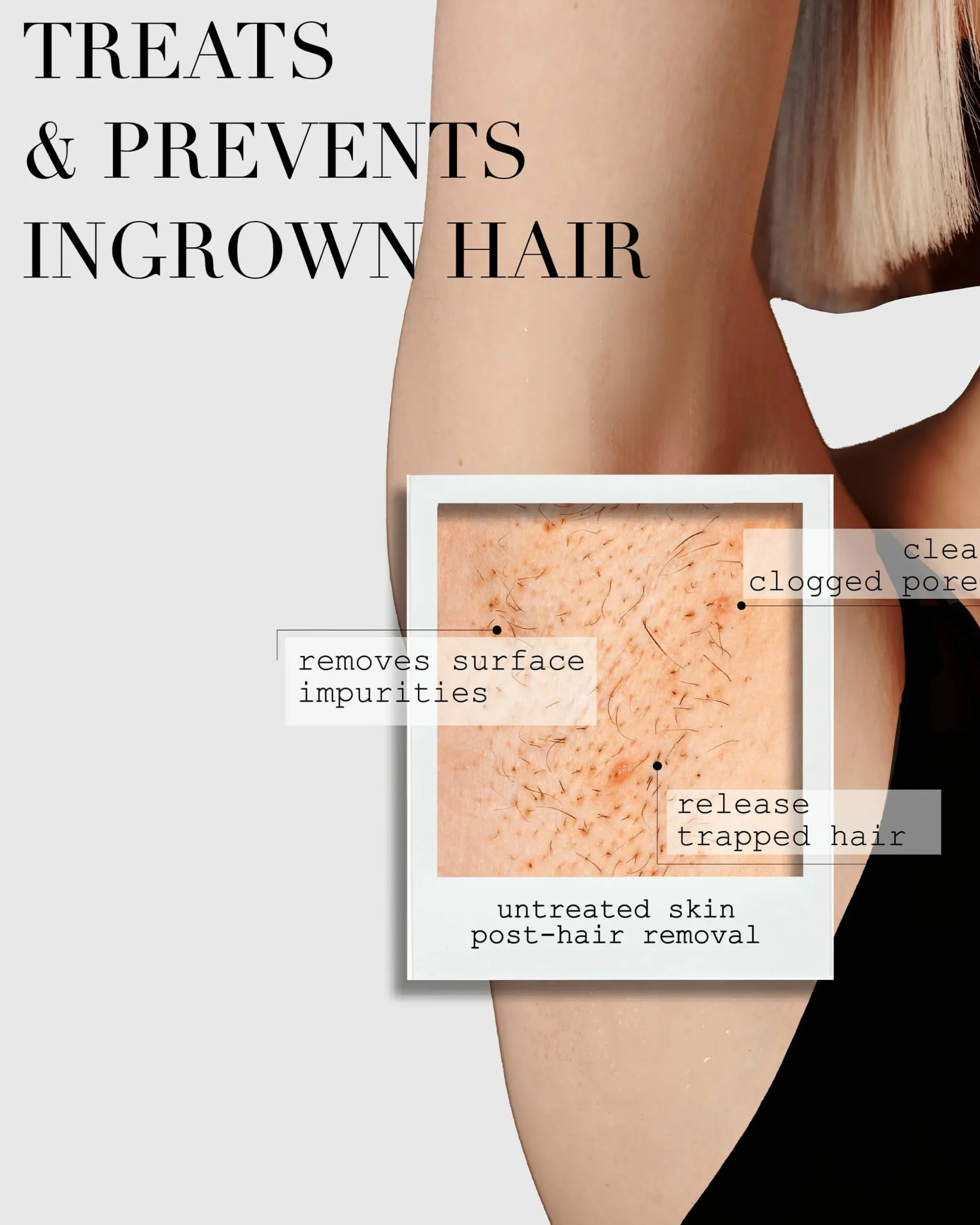 The Ingrown Bar